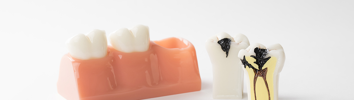 Cavity Treatment