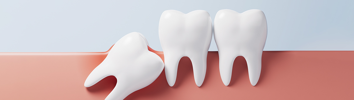 Wisdom Tooth Extraction